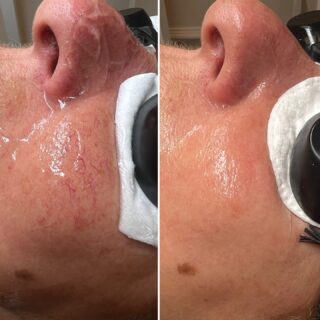 Efekt po 2 zabiegach!!!Taką ilość naczyń najlepiej rozłożyć na 2-3 zabiegi.
Zamykanie naczynek laserem to popularny zabieg, który pozwala na skuteczne usuwanie widocznych, rozszerzonych naczyń krwionośnych. Proces polega na zastosowaniu lasera, który emituje wiązkę światła o określonej długości fali. Energia ta jest pochłaniana przez hemoglobinę w naczyniach krwionośnych, co prowadzi do ich podgrzania, a w konsekwencji zamknięcia i obkurczenia. Zapraszam mgr kosmetologii Anna Bellazzi:) #zamykanienaczynek #zamykanienaczynekswinoujscie #laserowezamykanienaczynek #pajączkinatwarzy #laseroterapia #rumień #laseroweusuwanierumienia