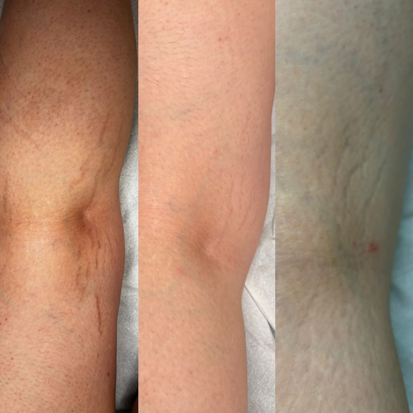 Rozstępy.
Nawet wieloletnie rozstępy nadają się idealnie do pracy z metodą ScarInk.
Zdjęcie od prawej strony przed pierwszym zabiegiem scarInk zostało wykonane na wiosnę. Po kilku miesięcznej przerwie Pani zdecydowała się na drugi zabieg we wrześniu (zdjęcie środkowe) - nastąpiła przebudowa skóry, spłycenie się rozstępów oraz naturalny proces ponownie kolagenu.
Zdjecie po lewej stronie to kolejne dwa miesiące czyli listopad. Zmiana koloru skóry tu w tym wypadku jest podyktowana zmianą temperatury na dworzu. Coraz płytszy rozstęp. To jeszcze nie koniec tych zmian i współpracy z ta podopieczną ale my już wiemy, że najbliższe lato będzie należeć do krótkich sukienek i odsłonietych nóg.
#kosmetologswinoujscie #rozstępy #scarink #bliznyswinoujscie #medycynaestetycznaswinoujscie #urodaswinoujscie #beautytherapist