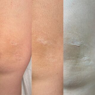 Blizna .Blizna na kolanie jest podyktowanwa usunięciem rozstępów przez chirurga.
Podejmując się pracy na niej nasz cel zabiegiem ScarInk jest tylko i wyłącznie jeden. Pozbycie się zwiotczałej skóry, jej przebudowa i elastyczność. #blizna #scarink #bliznyswinoujscie #kosmetologswinoujscie #gabinetkosmetologiiswinoujscie #scartreatment #swinoujscieuroda