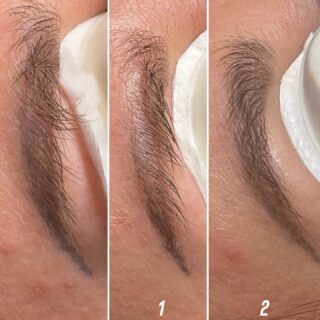 Jeśli posiadasz nieestetyczny makijaż permanentny to zapraszamy!
Na zdjęciu efekt 2 zabiegów usuwania laserowego.Laserowe usuwanie makijażu permanentnego to zabieg estetyczny, w którym wykorzystuje się wiązkę laserową do rozbijania pigmentu znajdującego się w skórze po wykonaniu makijażu permanentnego (np. brwi, ust, kresek na powiekach).Jak to działa?Laser emituje światło o określonej długości fali, które jest pochłaniane przez barwnik w skórze. Impuls lasera:
• rozbija cząsteczki pigmentu na mniejsze,
• następnie są one stopniowo usuwane przez organizm (układ limfatyczny).Co warto wiedzieć?
• Zabieg jest precyzyjny – działa głównie na pigment, oszczędzając otaczające tkanki.
• Aby całkowicie usunąć makijaż, zwykle potrzeba kilku sesji (np. 2–6), zależnie od koloru i głębokości barwnika.
• Po zabiegu skóra może być zaczerwieniona, lekko opuchnięta.Perła Centrum Kosmetologii & PMU
Ul.Wojska polskiego 2a-e/3b
Tel.502914041
www.centrumperla.pl#qswitchedlaser #pmuspecialist #kosmetologiaestetyczna
#zabiegilaserowe #skincareexpert #beautyclinic
#estetyka#beautycare #salonurody
#pmufail #pmucorrection#pmubrows #swinoujscieuroda #swinoujsciekosmetolog