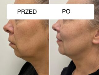 Kwas polimlekowy czyli najsilniejszy stymulator! U mojej Klientki podałam go w policzki i w bruzdy nosowo-wargowe co poprawiło owal twarzy i wypełniło ubytki tkanki w sposób bardzo naturalny. Dodatkowo kwas ten działa delikatnie rozjaśniając skórę.INFO:
Kwas poli-L-D-mlekowy w hybrydowej odsłonie!
-unikalna trzecia generacja kwasu
-długotrwałe efekty
-brak okresu rekonwalescencjiJest to kwas wykonywany w celu rewitalizacji i napięcia skóry twarzy oraz ciała. Wykorzystuje się go do redukcji głębokich zmarszczek, poprawy jędrności skóry, wypełnienia ubytków tkankowych.
Produkt zawiera kwas mlekowy o stężeniu 170 mg oraz 30 mg nieusieciowanego kwasu hialuronowego, w związku z czym gwarantuje niemal natychmiastowy efekt wypełnienia. Dzięki obecności mikrocząstek kwasu mlekowego PDLLA o okrągłym kształcie po około dwóch tygodniach następuje produkcja kolagenu. Trwająca przez pewien czas stymulacja jego produkcji pozwala na długo utrzymywać zadowalające efekty nawet 2 lat!!!------------------------------
Perła Centrum Kosmetologii & PMU
📌Wojska polskiego 2a-e/3b
📞502914041
www.centrumperla.pl#kwaspolimlekowy #swinoujscieuroda #kosmetologiaestetyczna #aesthetic #wolumetriapoliczkow