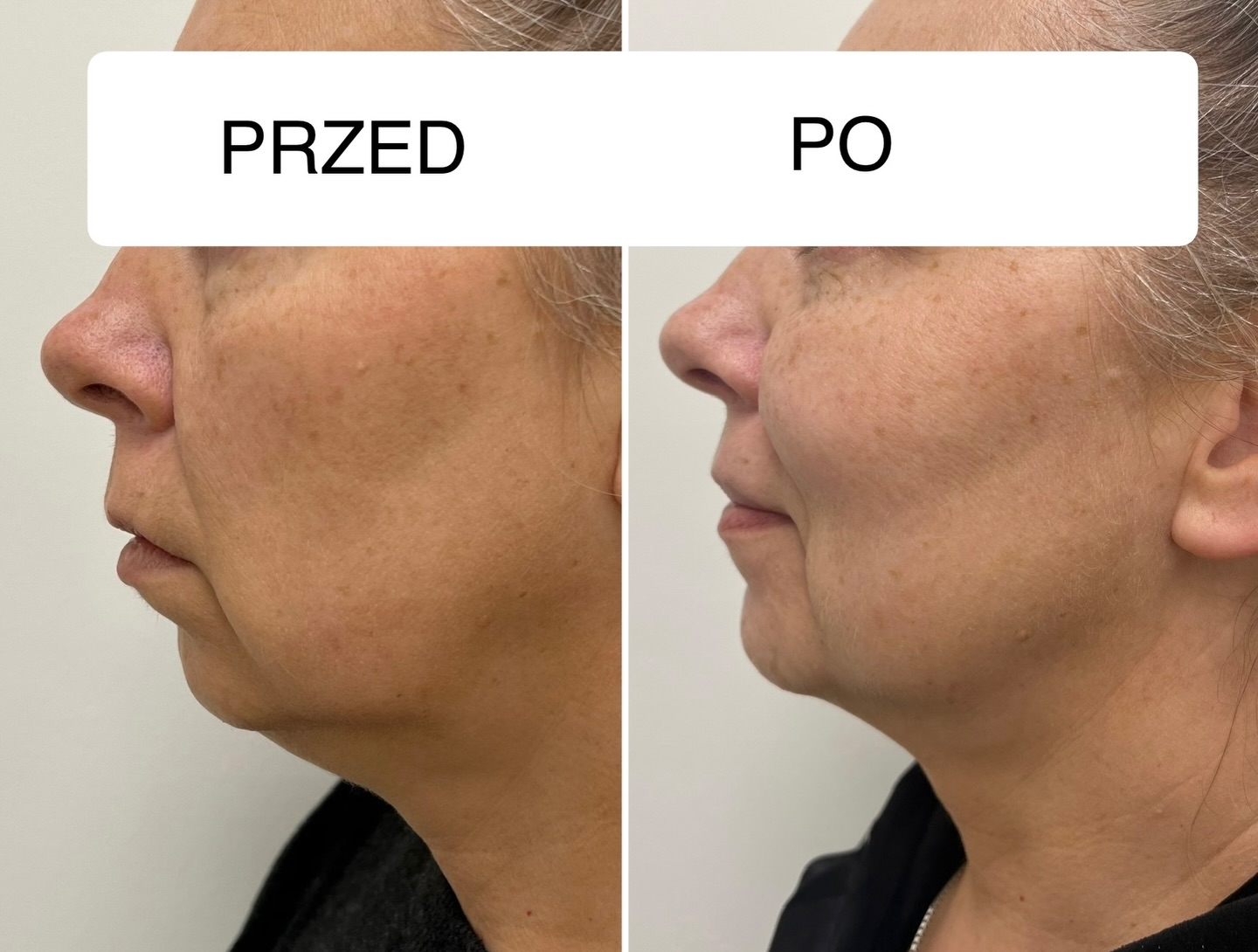 Kwas polimlekowy czyli najsilniejszy stymulator! U mojej Klientki podałam go w policzki i w bruzdy nosowo-wargowe co poprawiło owal twarzy i wypełniło ubytki tkanki w sposób bardzo naturalny. Dodatkowo kwas ten działa delikatnie rozjaśniając skórę.INFO:
Kwas poli-L-D-mlekowy w hybrydowej odsłonie!
-unikalna trzecia generacja kwasu
-długotrwałe efekty
-brak okresu rekonwalescencjiJest to kwas wykonywany w celu rewitalizacji i napięcia skóry twarzy oraz ciała. Wykorzystuje się go do redukcji głębokich zmarszczek, poprawy jędrności skóry, wypełnienia ubytków tkankowych.
Produkt zawiera kwas mlekowy o stężeniu 170 mg oraz 30 mg nieusieciowanego kwasu hialuronowego, w związku z czym gwarantuje niemal natychmiastowy efekt wypełnienia. Dzięki obecności mikrocząstek kwasu mlekowego PDLLA o okrągłym kształcie po około dwóch tygodniach następuje produkcja kolagenu. Trwająca przez pewien czas stymulacja jego produkcji pozwala na długo utrzymywać zadowalające efekty nawet 2 lat!!!------------------------------
Perła Centrum Kosmetologii & PMU
📌Wojska polskiego 2a-e/3b
📞502914041
www.centrumperla.pl#kwaspolimlekowy #swinoujscieuroda #kosmetologiaestetyczna #aesthetic #wolumetriapoliczkow
